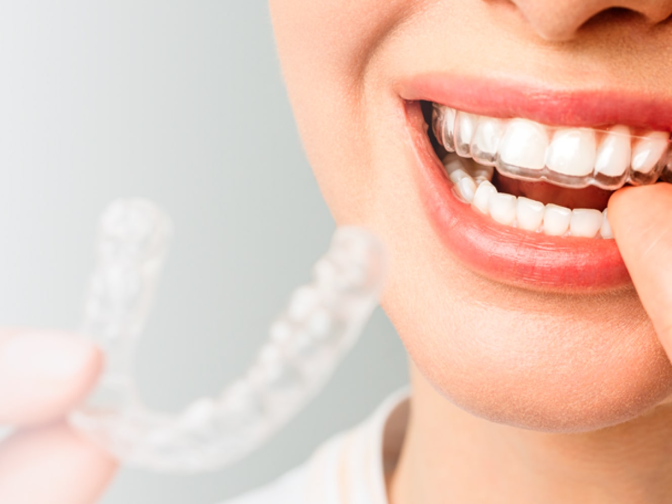 Установка элайнеров